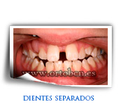 dientes separados